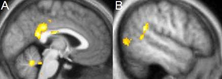 Increase in gray matter concentration Posterior