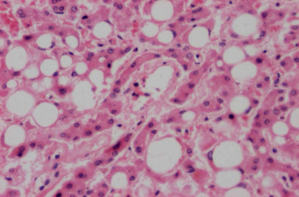 Fatty change of the liver 1 2 4 3 1 Fatty vacuoles in the