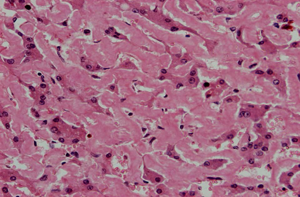 Amyloidosis of the liver 2 4 3 1 4 3 1 Endothelial cells of sinusoids 2