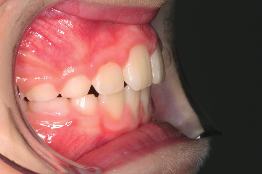 10 months LM-Activator aligns teeth, activates mandibular growth and expands the arch