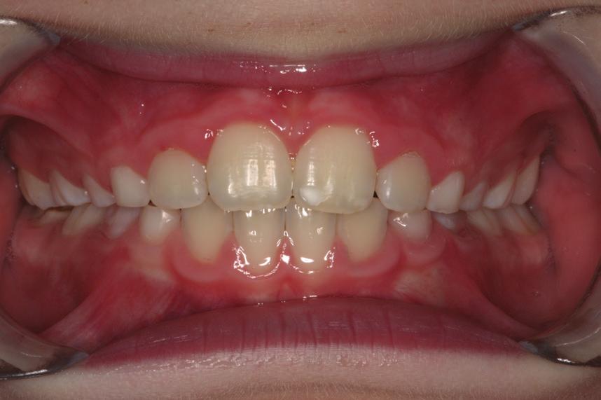 Possibility to treat in mixed dentition: - Intercept interferences and early signs of