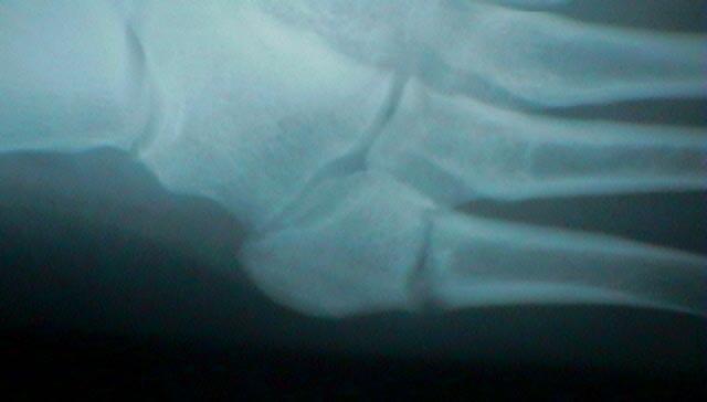 5 th Metatarsal Fracture Diaphyseal Fracture Acute vs.