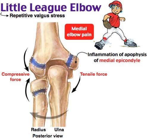 Little League Elbow medial tension & lateral compression more likely