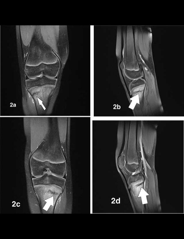 Stress Fractures Early in process, plain films may be