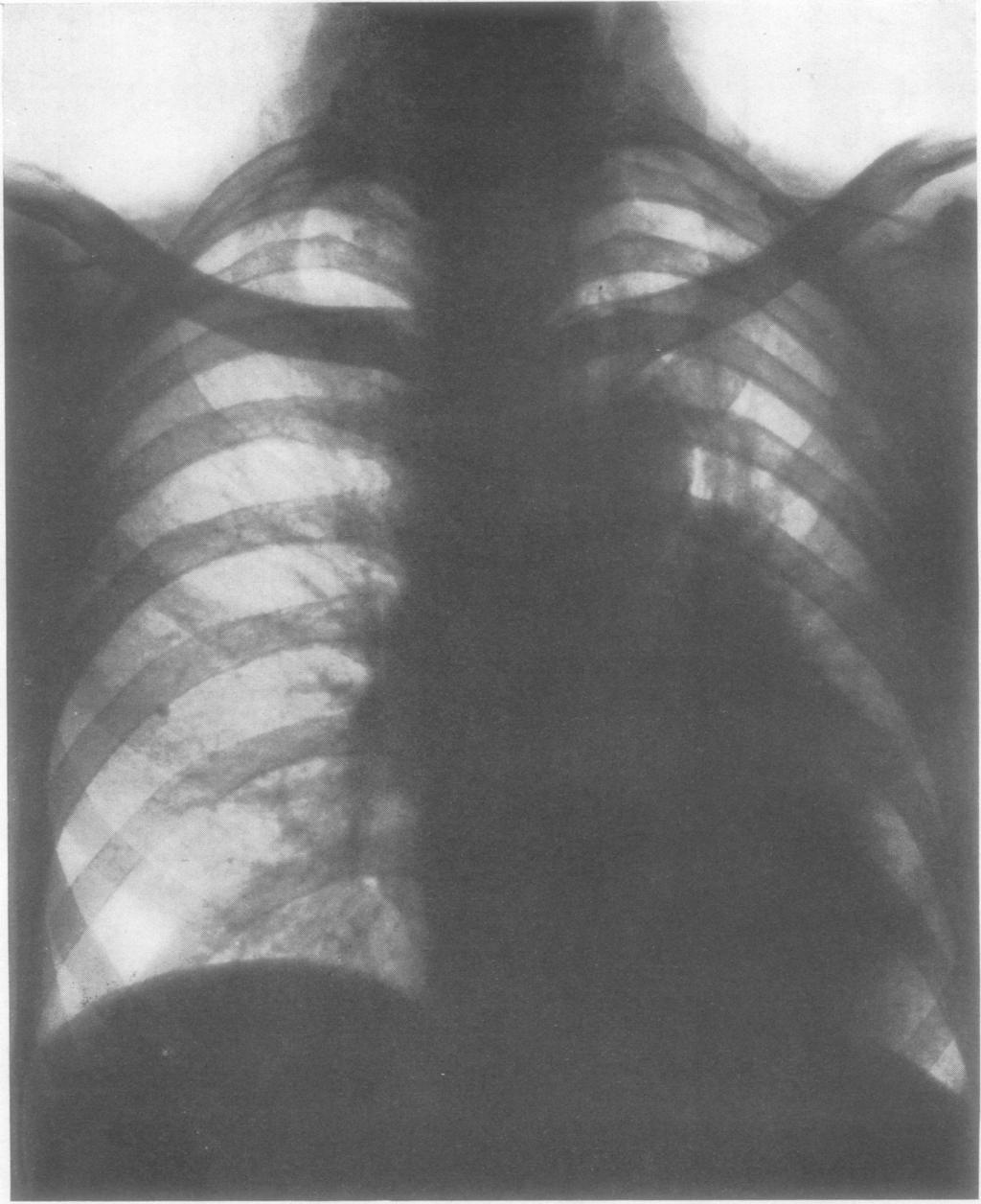 370 Thorax: first published as 10.1136/thx.5.4.369 on 1 December 1950. Downloaded from http://thorax.bmj.com/ FIG. 1.-Radiograph taken soon after bronchoscopy (Case 1).