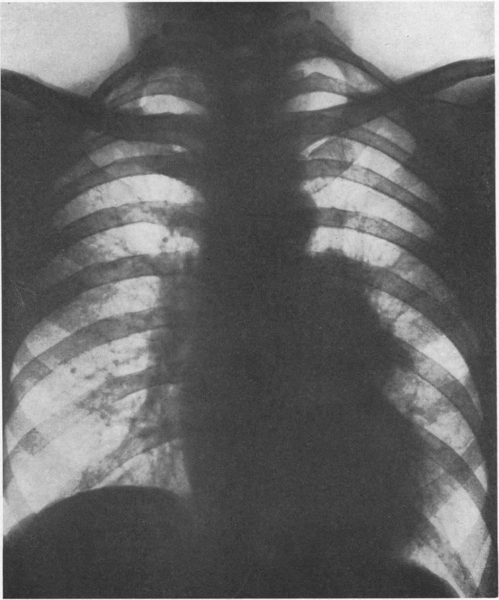 PERFORATION OF THE TRACHEA AND BRONCHUS The radiograph (Fig.