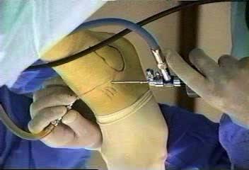 anterolateral soft tissue impingement treatment Partial synovectomy Do not