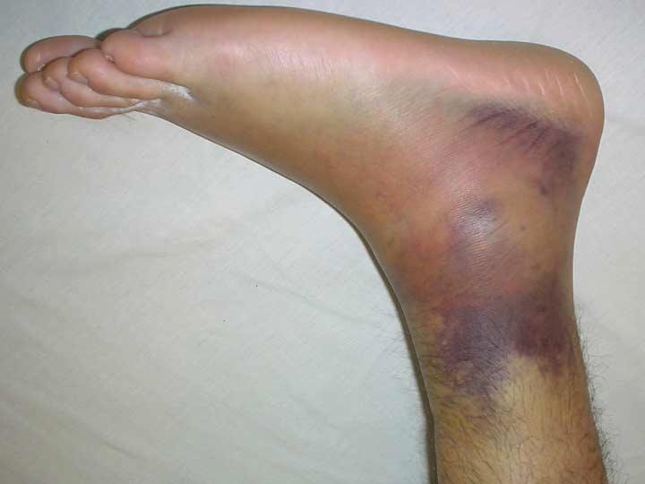 Ankle sprains are among the most