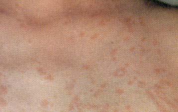 Drug Rash Usually begins on chest and later spreads to upper arms and thighs Itches Maculopapular Urticaria/hives