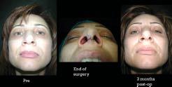 length of the nose. The tip was augmented with transverse rectangular umbrella graft and crushed on lay grafts.