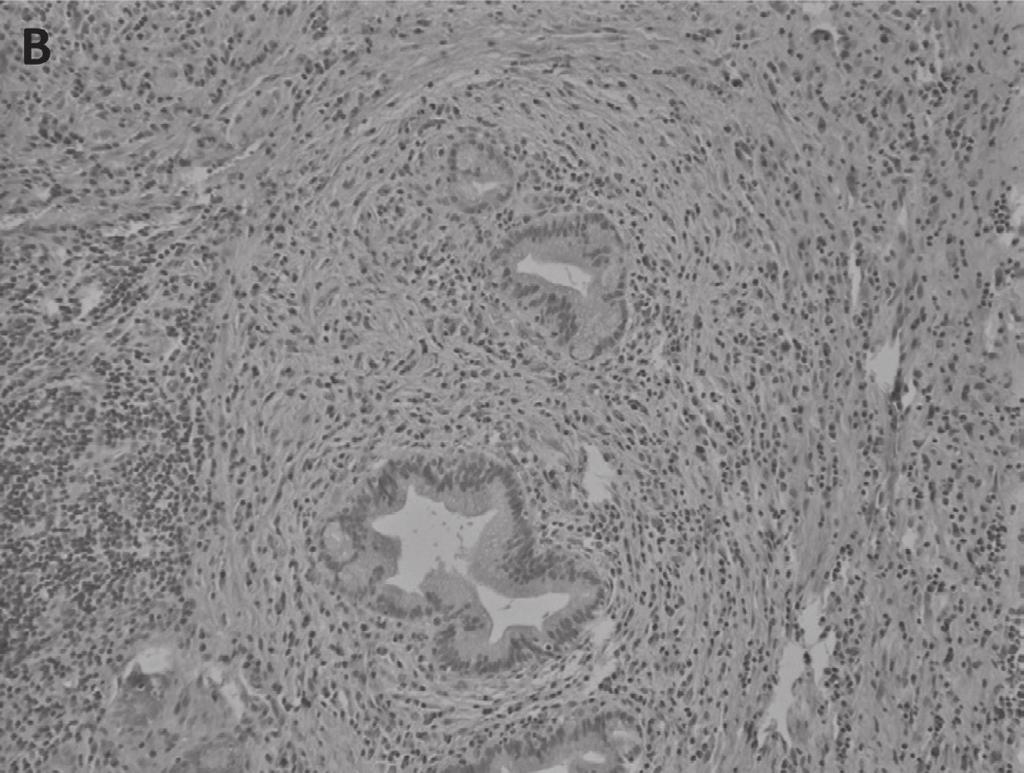 pattern, dense fibroblast and inflammatory cells surrounded the glands (H&E stain, 200X), (C) With immunohistochemical staining for IgG showed diffuse IgG positive cells.