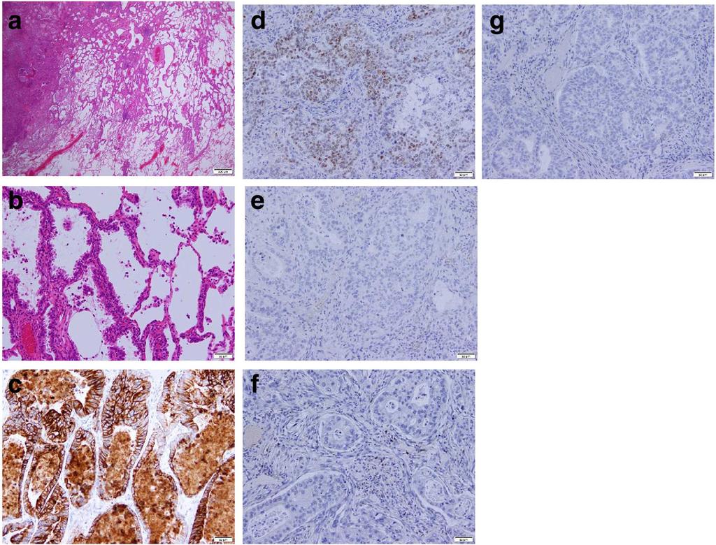 5c, d), similar to the cholangiocarcinoma, and negative for thyroid transcription factor-1, napsin A, and CK20 (Fig. 5e g). Additionally, an LN metastasis was detected in a resected regional LN.