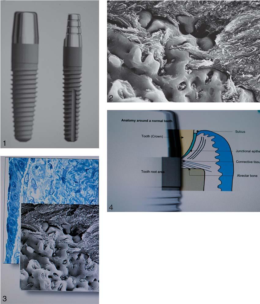 Jack Hahn FIGURE 1. The implant features an integral fixed abutment and is available in several diameters, including 4.3 and 3.0 mm (shown here). FIGURE 2.