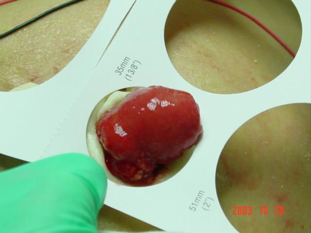 Using the measuring guide find the whole closest to the size of the stoma The