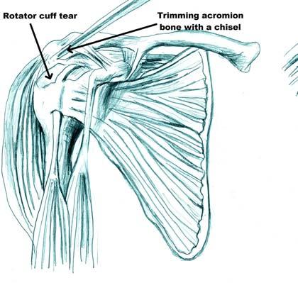 Rotator Cuff repair is a fairly major operation which has a twelve month rehabilitation period. The results are generally very good but even an excellent result does not give you a normal shoulder.