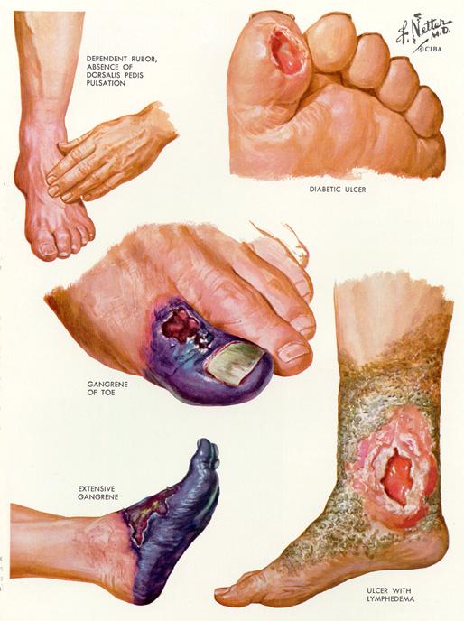 peripheral vascular disease (c)