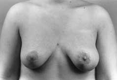 (Figure 2). C E G Figure 2. A, C, E, Preoperative views of a 26-year-old woman. G, H, Postoperative views immediately after the L-scar technique.