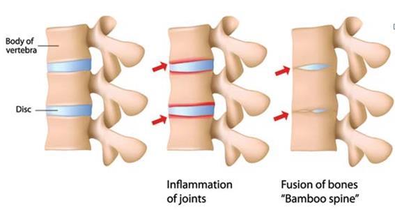 How Spinal Damage Progresses Without Treatment In Psoriatic Arthritis the ligaments of the spine become inflamed at the points where they attach to the spinal vertebrae.