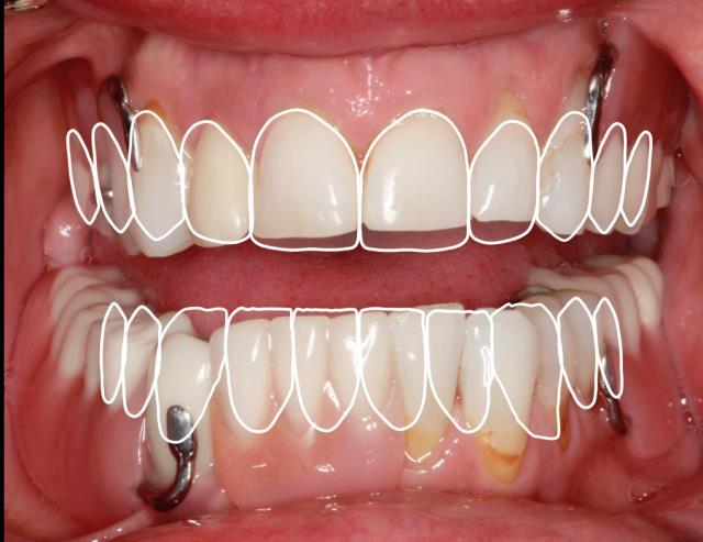 Steps in construction of an interim dental implant-supported hybrid prosthesis: 1.