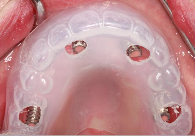 At the time of conversion, place the transitional abutments and check for clearance that may require a slight correction (removal) of soft or hard tissue a.