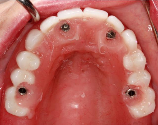 9. If the patient is fully edentulous, work to position the upper teeth first using the palate as