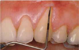 The width is measured with periodontal probe of recession in the widest