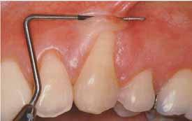 The width of the interdental papilla is determined with periodontal probe