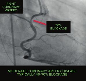 WHAT IS A CT Coronary Angiogram? A computerized tomography (CT) coronary angiogram is an imaging test that looks at the arteries that supply your heart with blood.