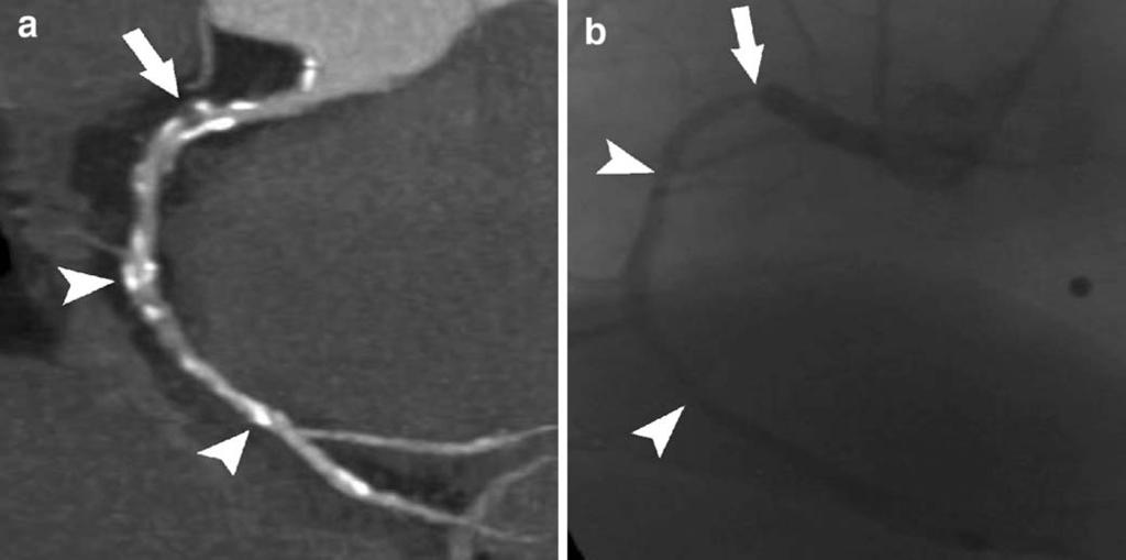 2744 Fig. 2a, b Dual-source CT coronary angiography in a 69-year-old man with suspected coronary artery disease (mean heart rate during scanning 77 bpm, Agatston score 1,316).