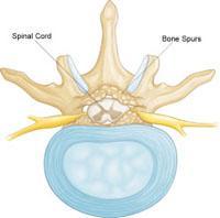 Spinal Stenosis Spinal stenosis occurs when the space around the spinal cord narrows and puts pressure on the cord and spinal nerves.