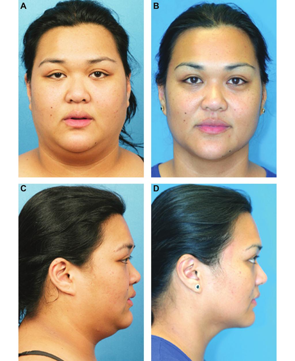 18 Aesthetic Surgery Journal 32(1) Figure 13. (A, C) This 29-year-old woman presented with platysmal banding on animation and fat deposition.
