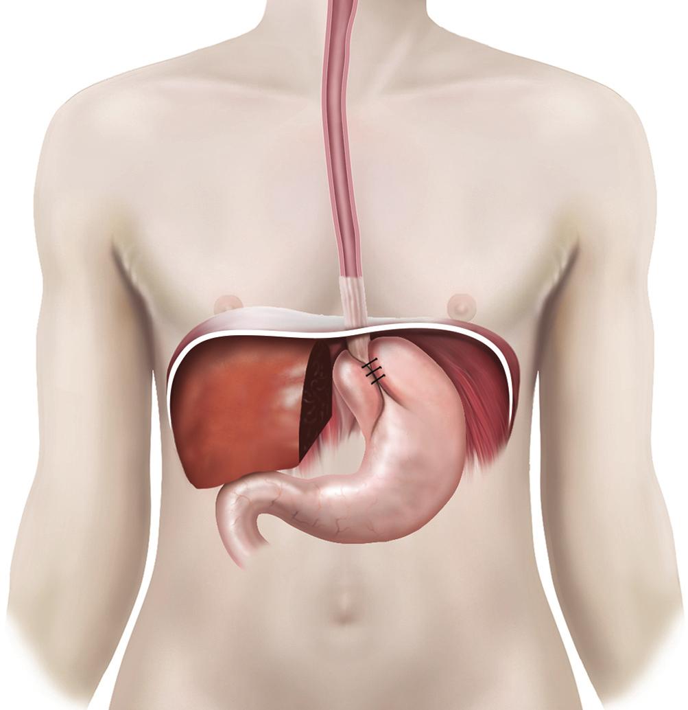 Are there any alternatives to surgery? Medicine that lowers the acid content in your stomach is effective at controlling symptoms and healing the inflammation in your oesophagus.
