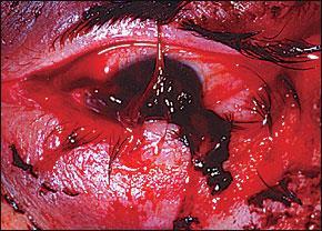 eyelid lacerations, a corneascleral