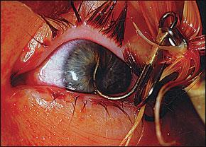 Penetrating Injuries Fishing hook in the left eye.