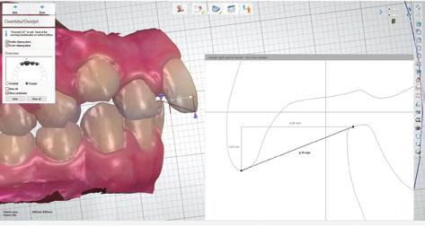 Re-fabricate lost and broken appliances. Make diagnosis Analyze mal-occlusion digitally. Easy analysis of arc shapes, overjet/ overbite, Bolton ratios, occlusion and spaces.
