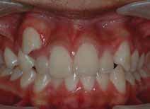 time: 20 months Initial intraoral photos showing maxillary right