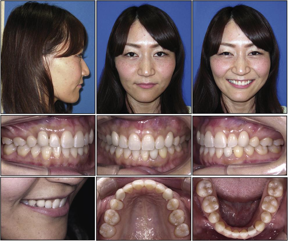 S145 Fig 11. Three-year postretention facial and intraoral photographs.