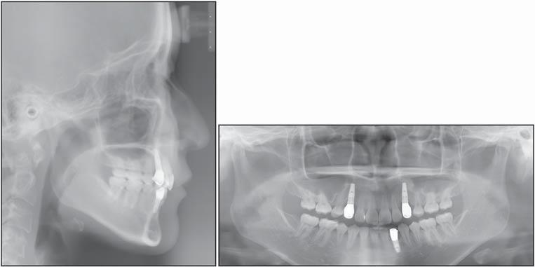 S146 Fig 12. Lateral cephalogram and panoramic radiograph at 3 years postretention.