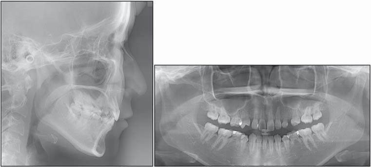 S138 Fig 2. Pretreatment dental casts. Fig 3. Pretreatment lateral cephalogram and panoramic radiograph.