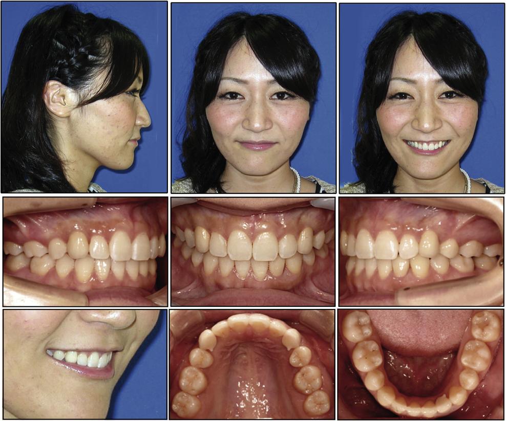 S142 Fig 7. Posttreatment facial and intraoral photographs. be achieved.