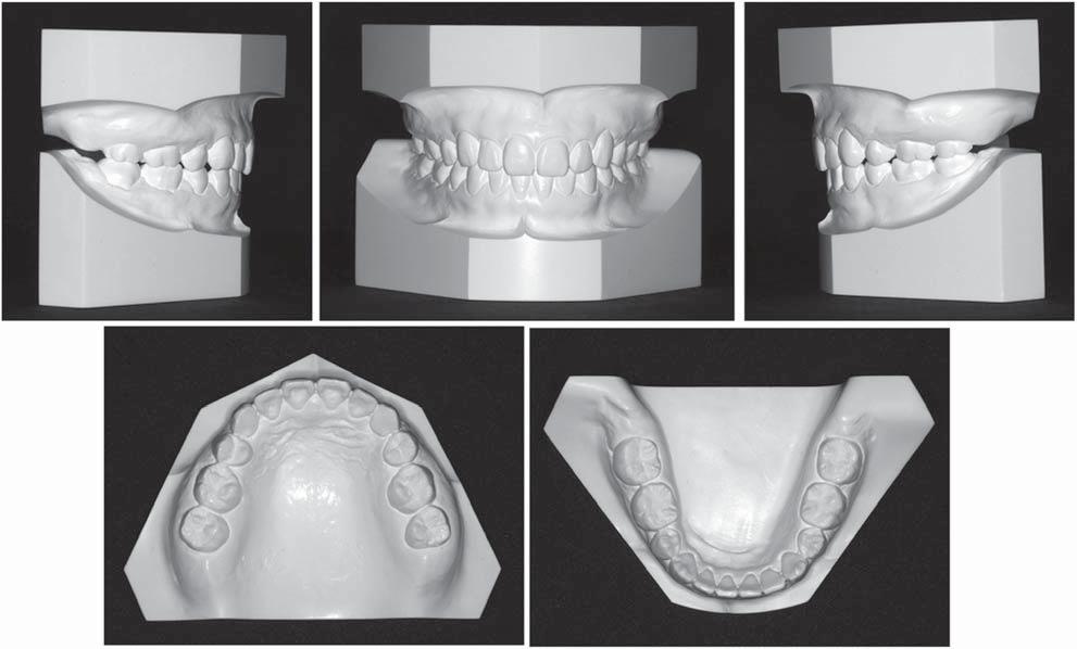 S143 Fig 8. Posttreatment dental casts. Fig 9. Posttreatment lateral cephalogram and panoramic radiograph.