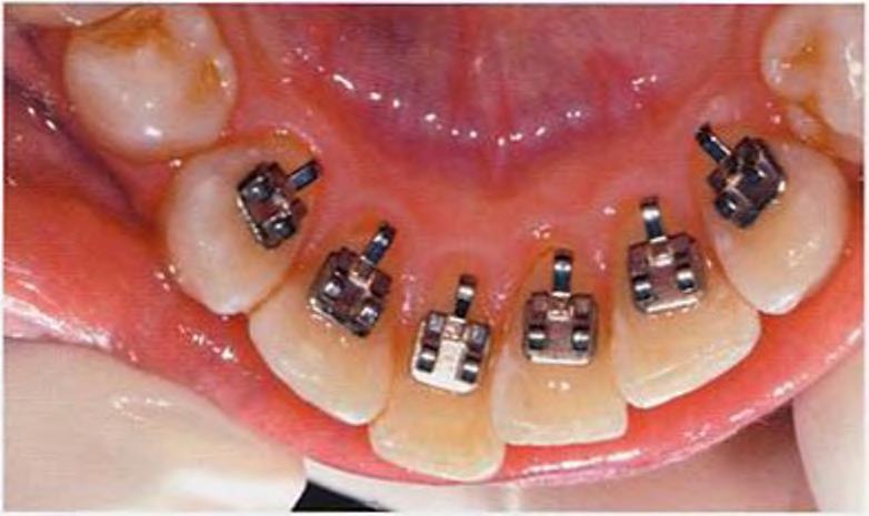 To summarize 2D lingual brackets - can be used for all teeth, - allow a vertical insertion of the archwire, - do not have a rectangular slot, which is