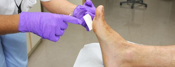 How to Treat and Prevent a Diabetic Foot Ulcer Research suggests that 15 percent of all patients with diabetes develop diabetic foot ulcers, which are open sores or wounds typically located on the