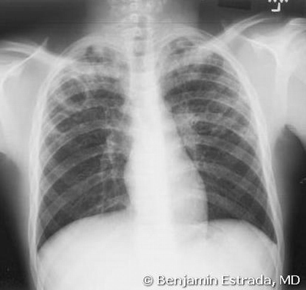 Childhood TB - Various X ray Presentations: Adult type