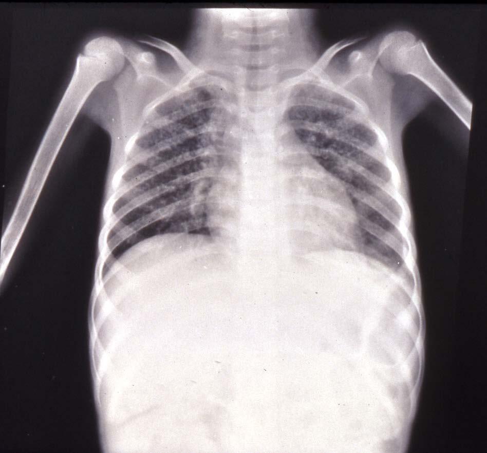Childhood TB - X ray Presentations