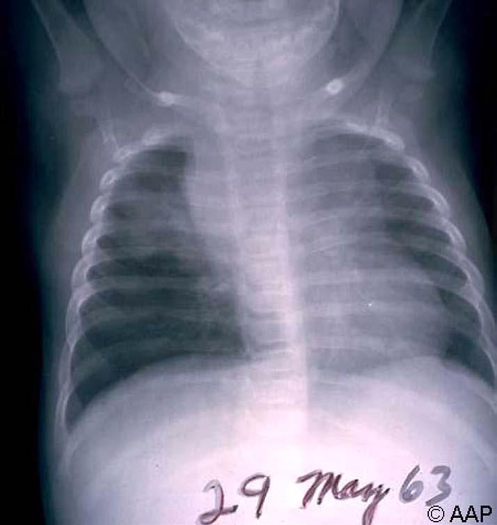 Childhood TB - X ray Presentations: Preschool aged