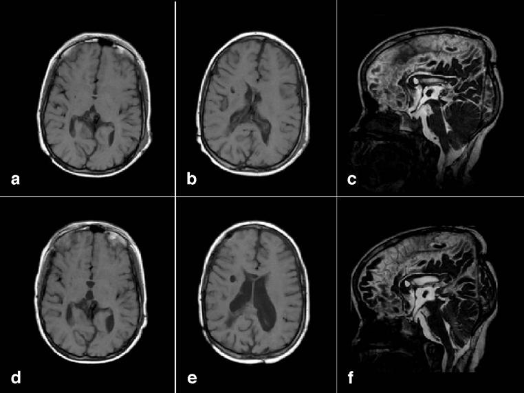 758 Childs Nerv Syst (2008) 24:757 761 which was treated with a ventriculoperitoneal shunt. One month later, a Chiari type II malformation was treated by a suboccipital craniotomy and a duraplasty.