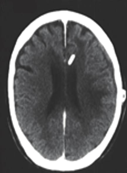 shunt, subdural hygroma can be observed (c) CT