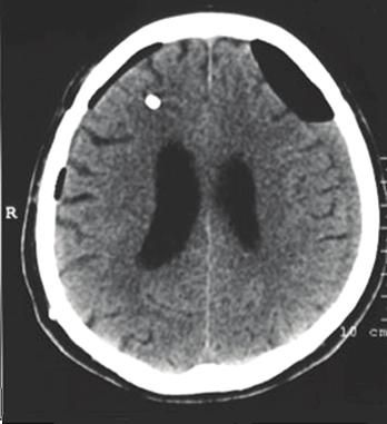 and bilateral traumatic chronic subdural