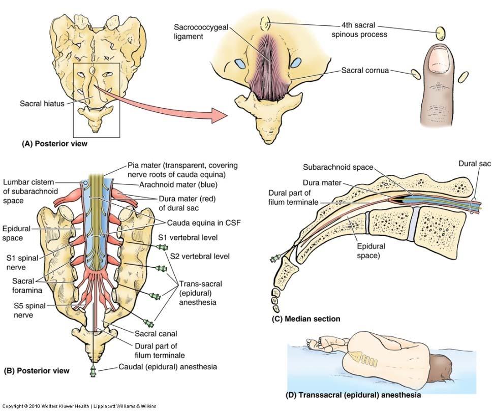 Caudal epidural anesthesia during delivery Into sacral hiatus Sacral and coccygeal